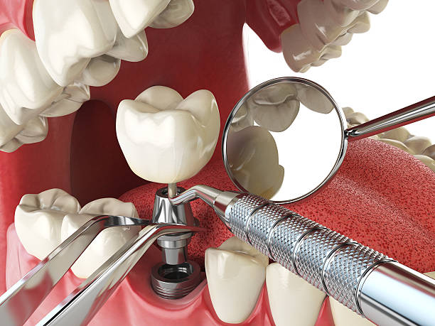 Best Emergency Wisdom Tooth Extraction in Coplay, PA